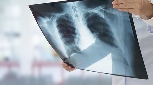 Quilotórax: tratamientos más eficaces
