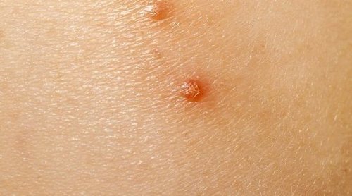 En qué consiste la enfermedad del molusco contagioso