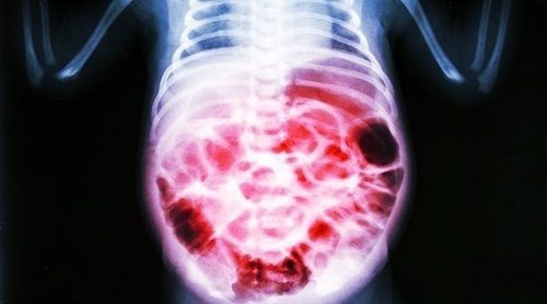 Qué es enterocolitis necrosante