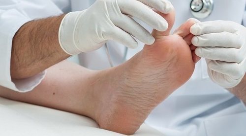 Qué es una verruga plantar