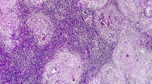 Por qué el cuerpo no destruye las células cancerosas