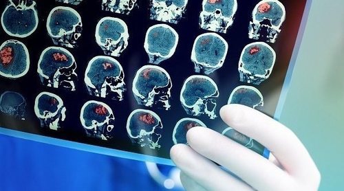 Síntomas sutiles que indican que tienes un tumor cerebral