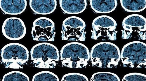 Síntomas de un tumor en el cerebelo