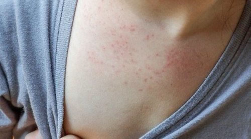 Virus que causan erupciones cutáneas