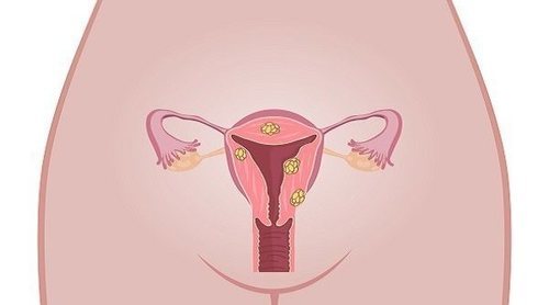 Cáncer vulvar