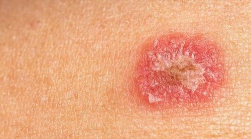 Cómo identificar los síntomas del impétigo