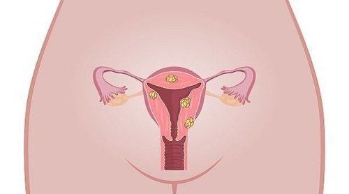 Molestias vaginales en mujeres mayores