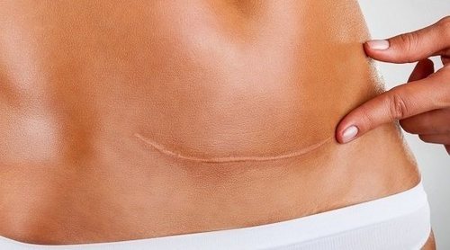 Cómo deshacerte de las cicatrices de foliculitis
