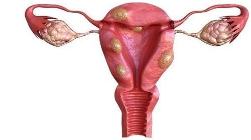 Señales de la contracción de fibromas